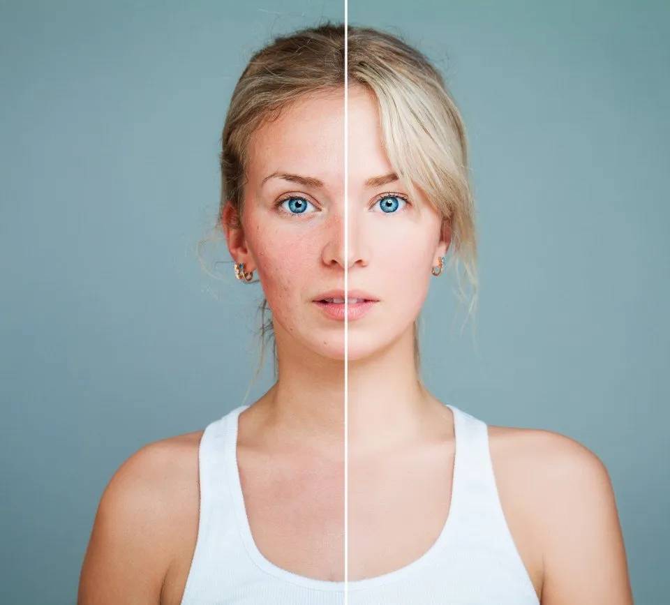donna prima e dopo una cura dermatologica
