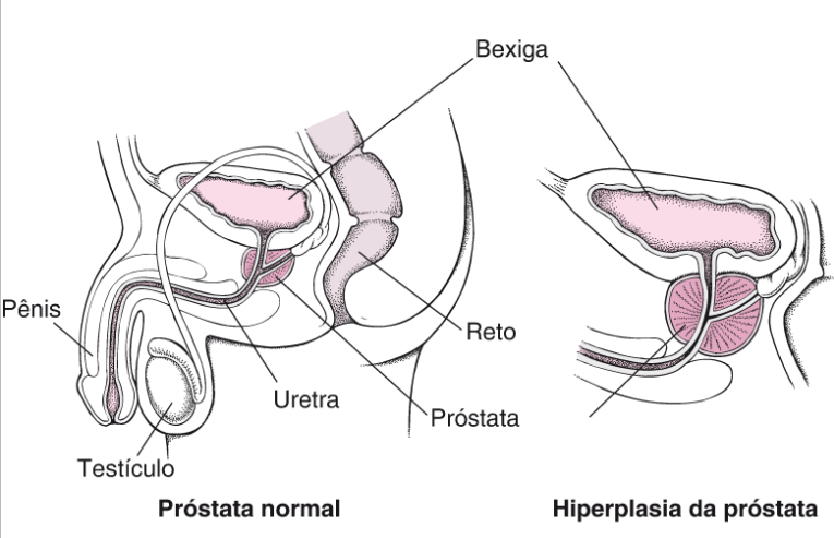 hierplasia-prostata-dr-eder-rocha-urologista-picos