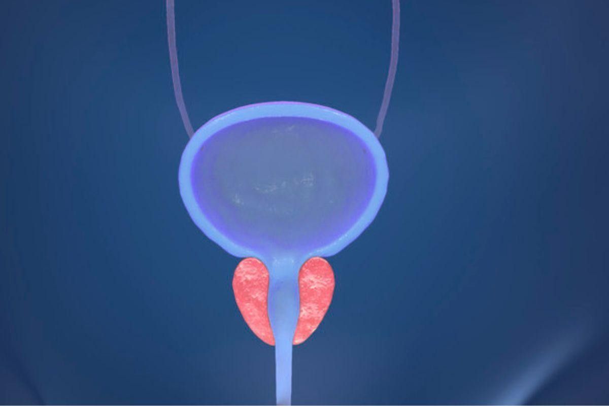 hiperplasia-protastica-benigna-sintomas-dr-eder-rocha-urologista-picos-piaui