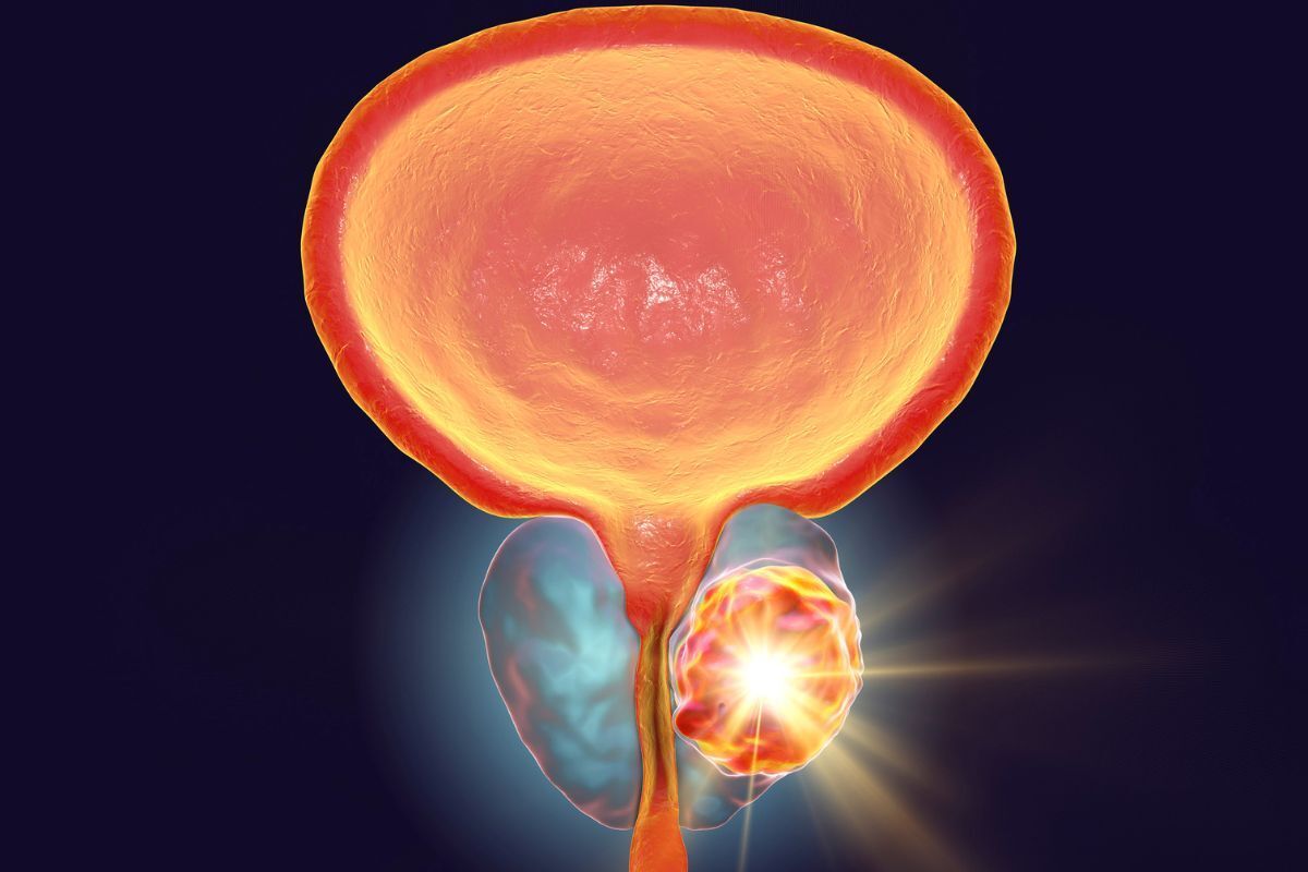 medico prostata dr eder rocha urologista picos