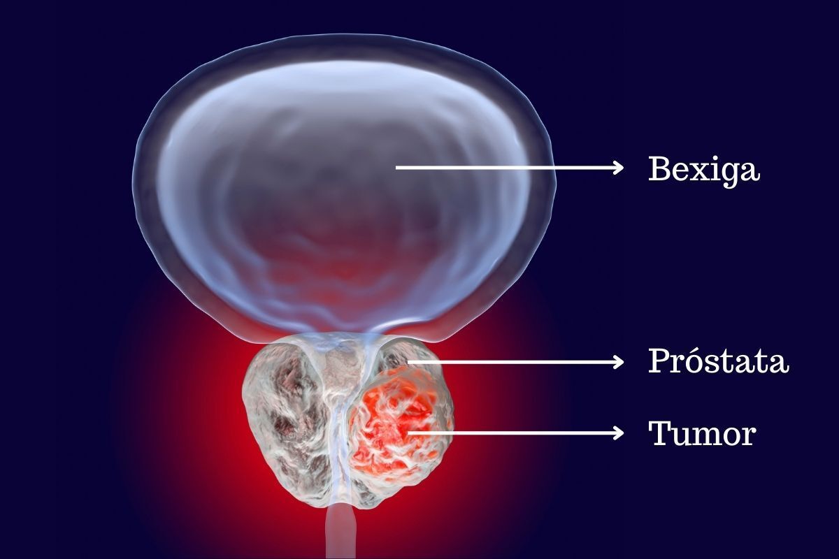 tumor-prostata-dr-eder-rocha-urologista-picos-piaui