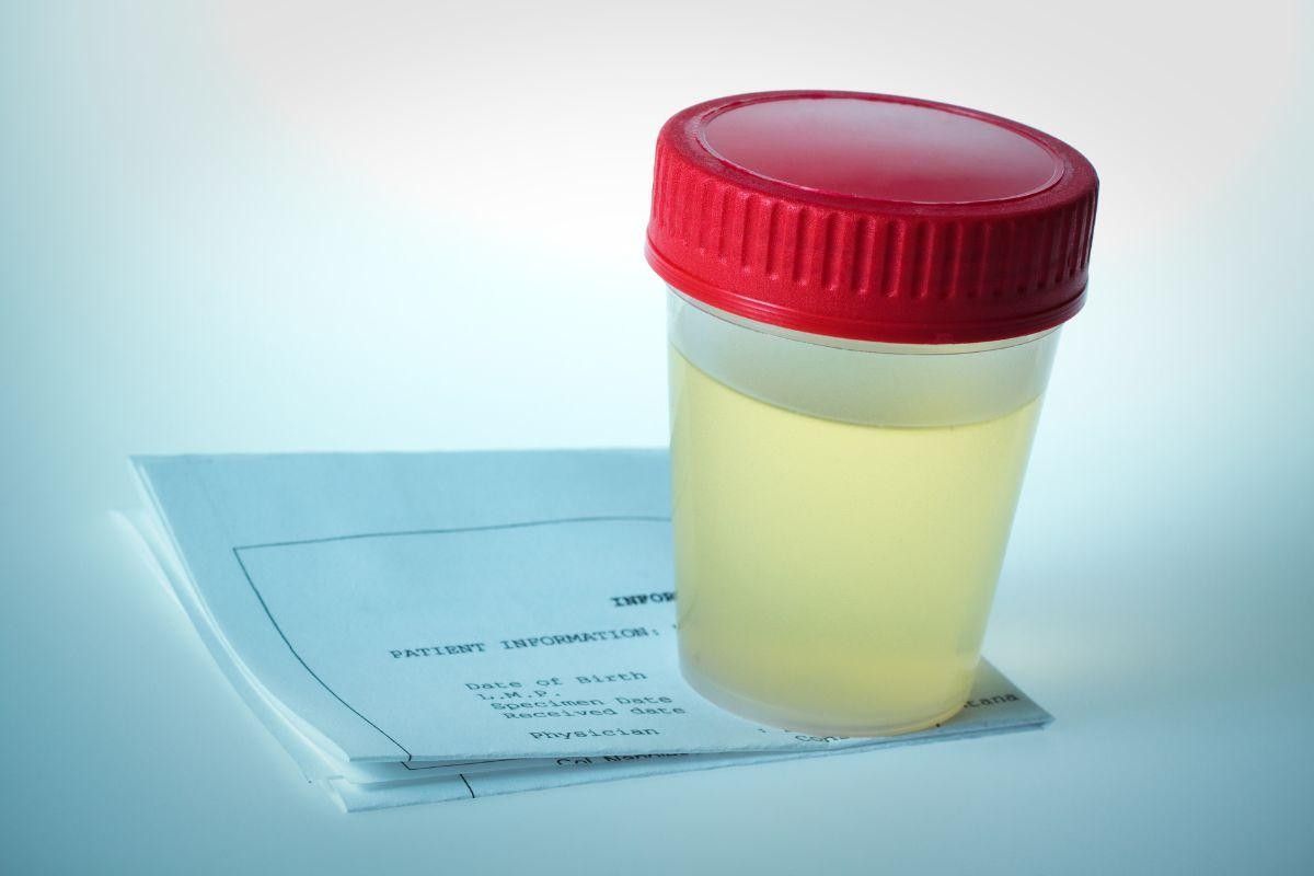 uretrite-diagnostico-dr-eder-rocha-urologista-picos-piaui