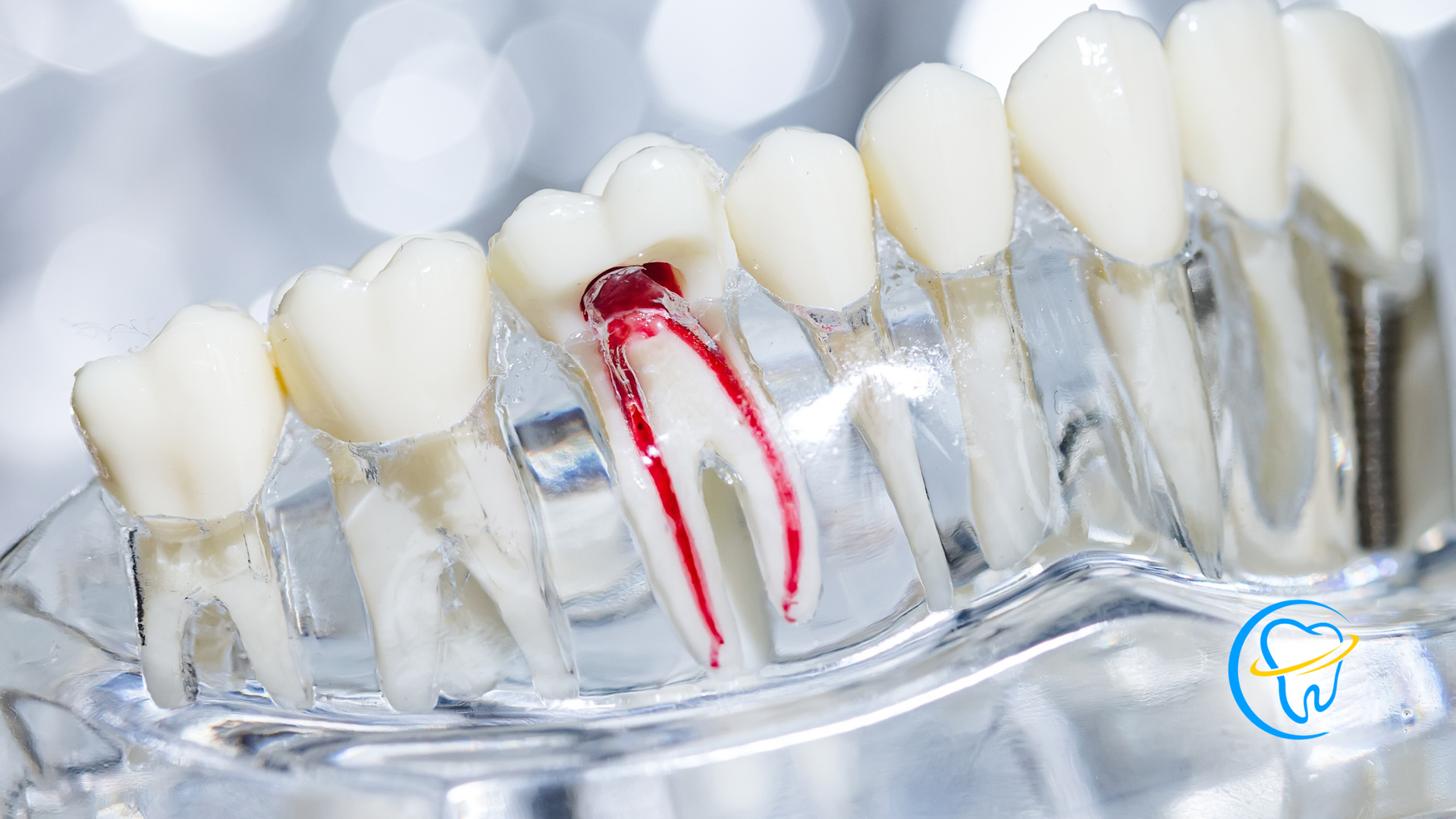 A close up of a model of a tooth with a hole in it.
