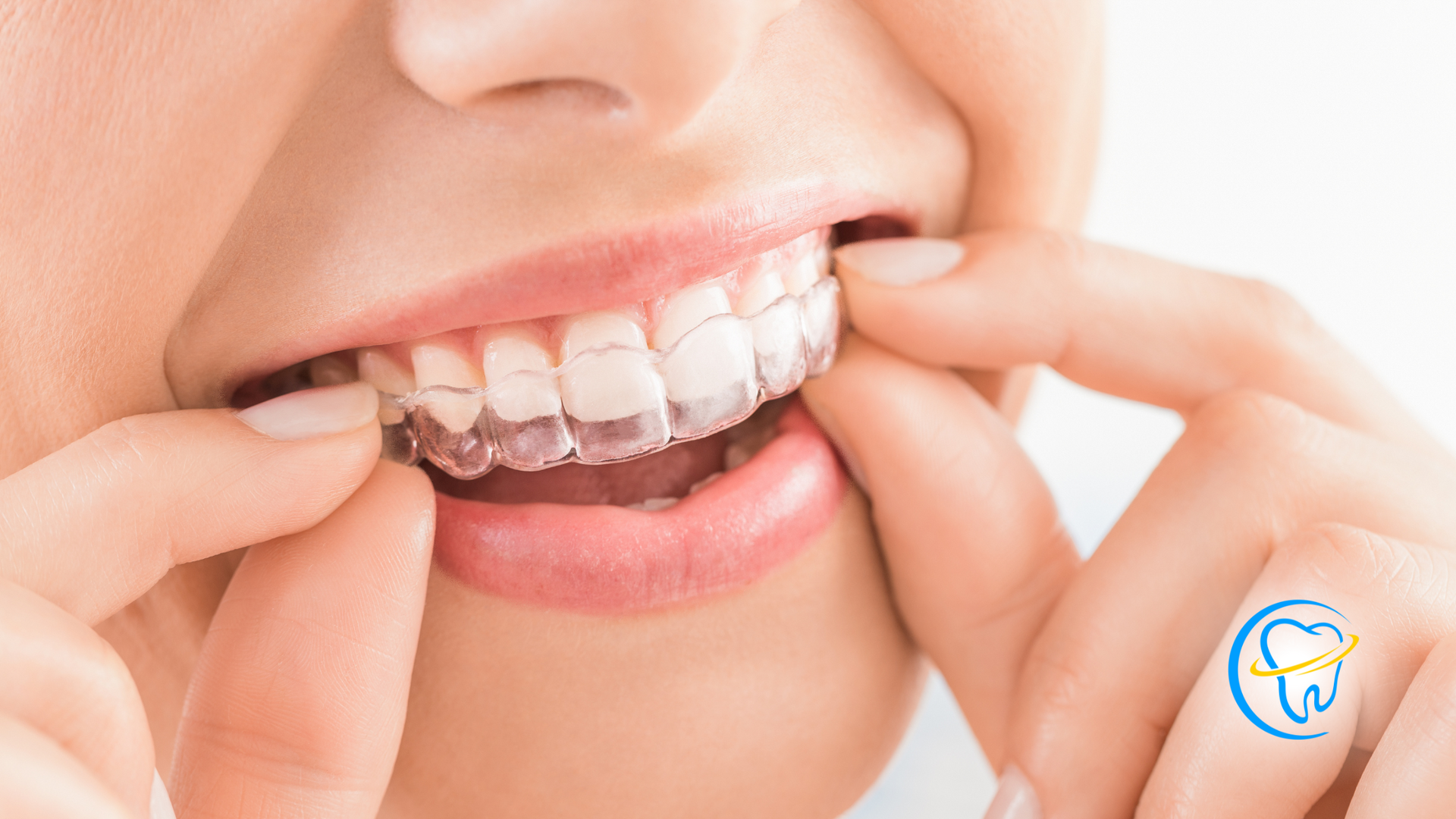 A woman is putting invisible braces on her teeth.