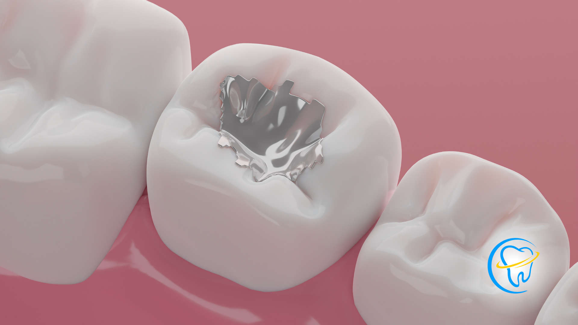 A close up of a tooth with a filling in it.
