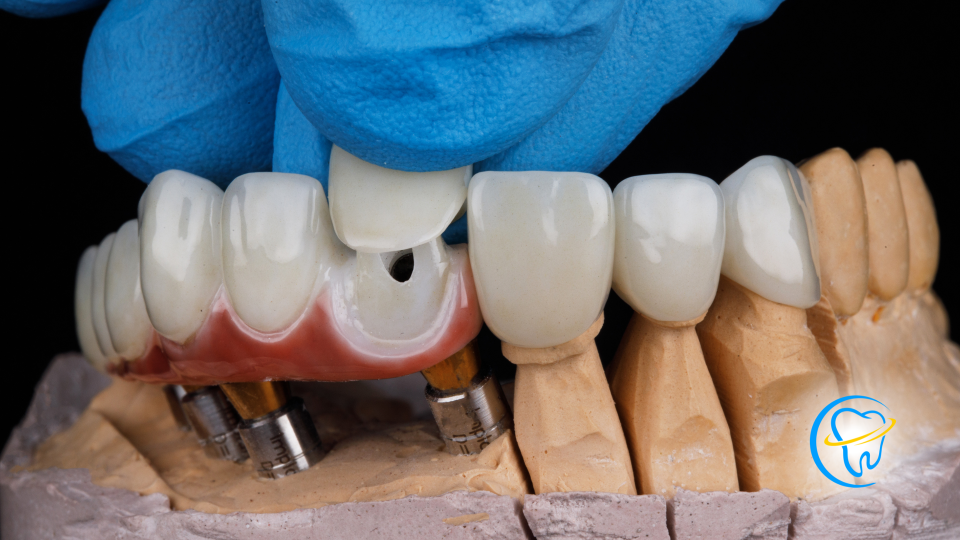 A close up of a model of a person 's teeth with dental implants.