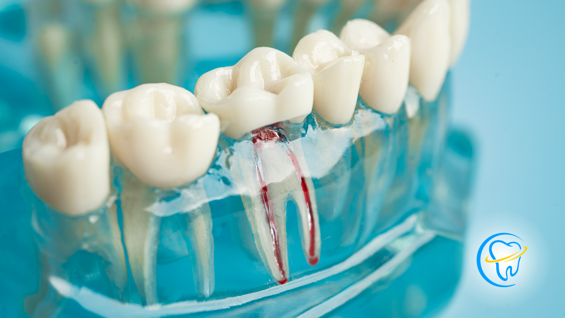 A model of a tooth with a root canal in it.