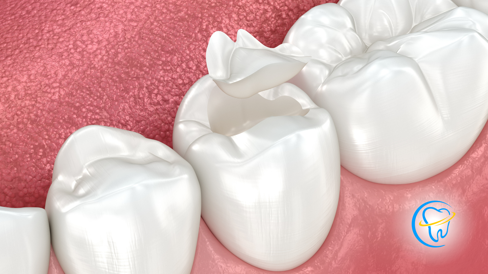 A close up of a tooth with a filling in it.