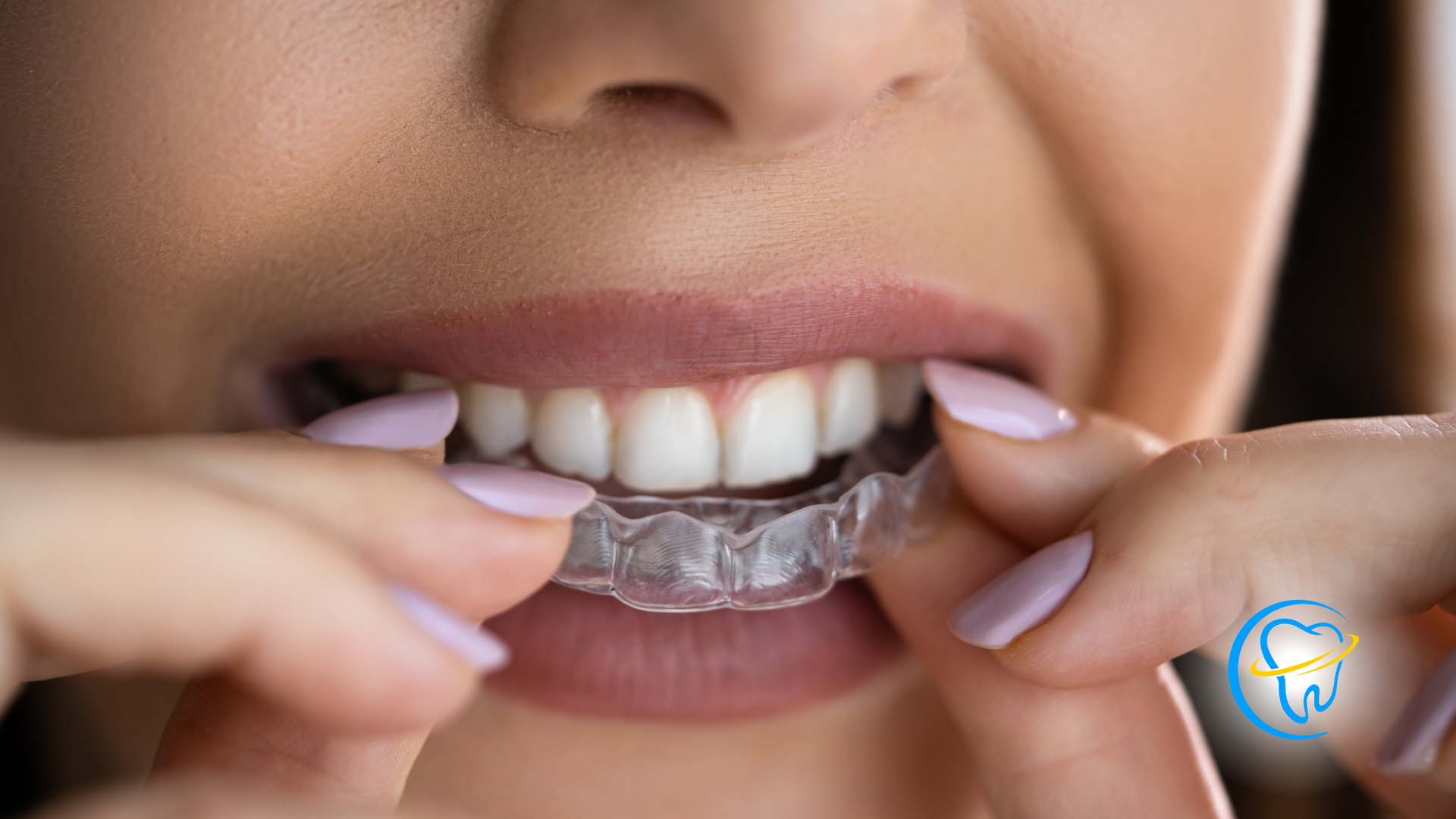 A woman is putting a clear brace on her teeth.