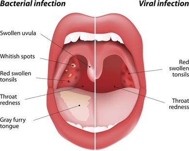Giardiasis tonsillitis