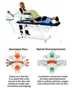 Herniated Disc and Spinal Decompression