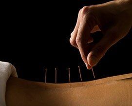 Shallow Dry Needling - Massage Therapy in Palmerston, NT