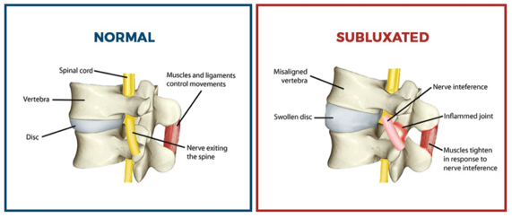 subluxated vs. normal spine