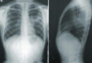 Two x-rays of a person 's chest and abdomen.