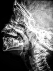 Lateral View Xray of Upper Cervical Spine