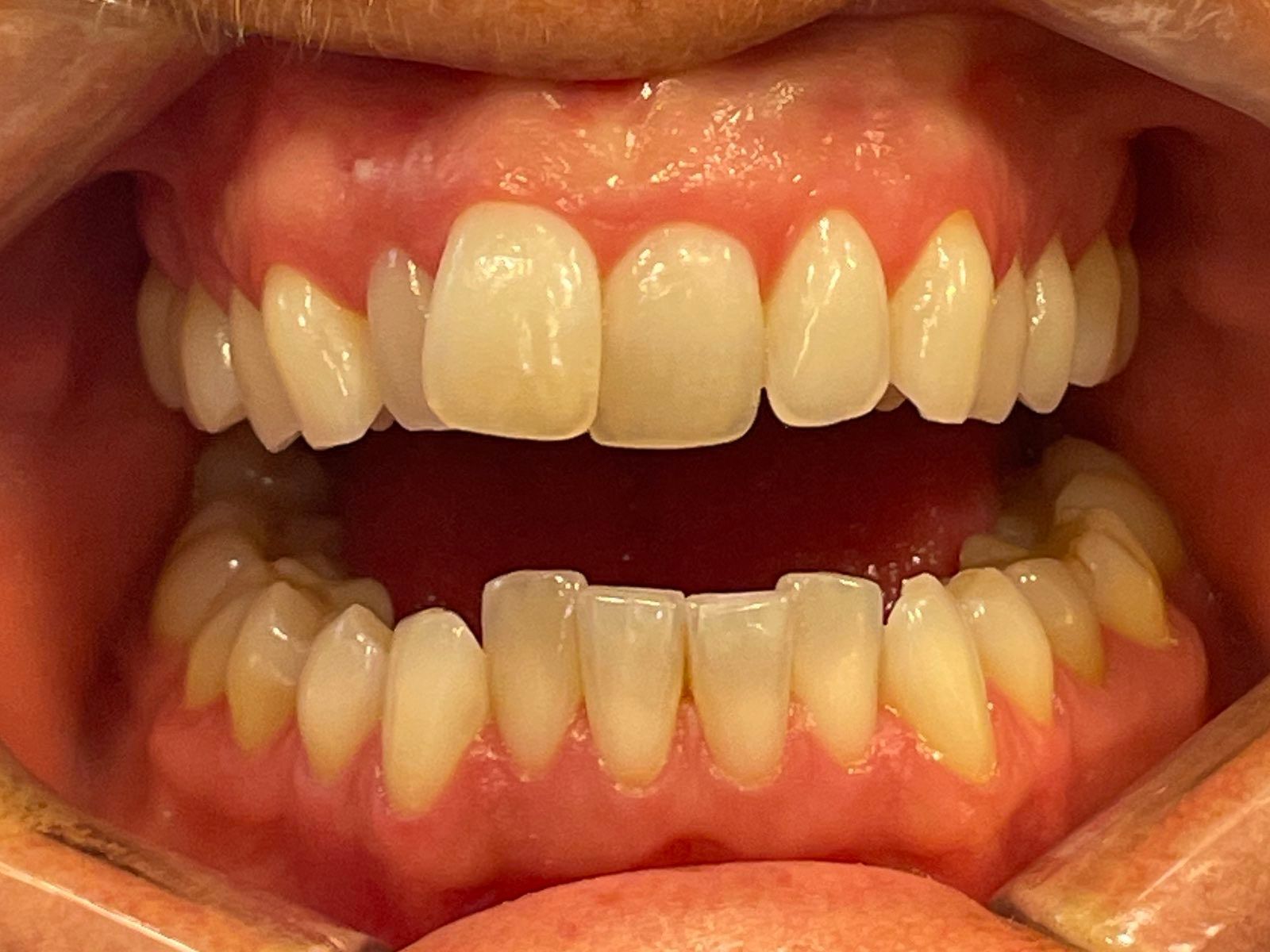 Før behandling med usynlig tannregulering fra Invisalign. Behandling utført av tannleg