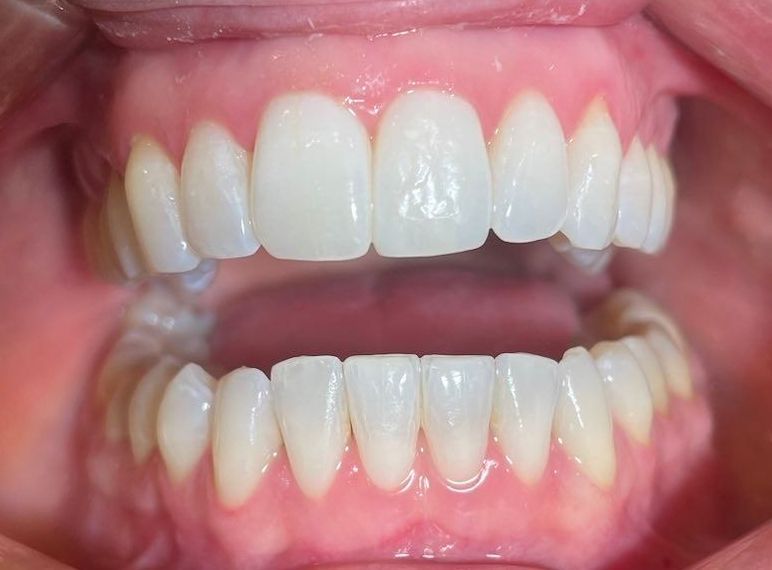 Etter behandling med usynlig tannregulering fra Invisalign. Behandling utført av tannlege Nedd.