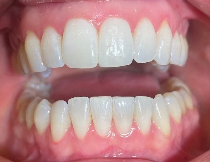 Usynlig tannregulering fra Invisalign, resultater før og etter. Utført av tannlege Nedd.