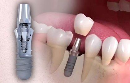 A person is holding a dental implant in their mouth.