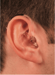 Phonak Naida SP/UP with custom-made earmold