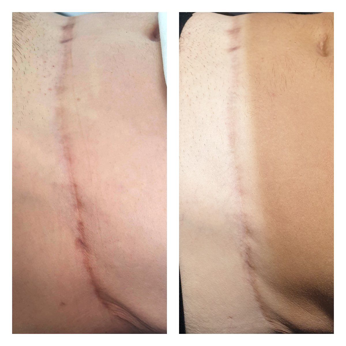 Plasma Medi Lift littekens behandeling