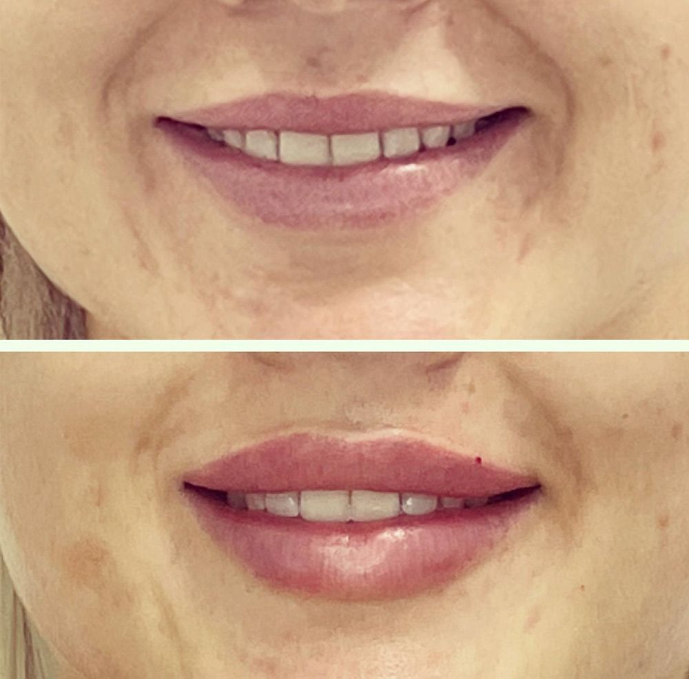 Before And After LED Light Therapy — Jina Robinson Skin-Cos-Medix In Albion Park NSW