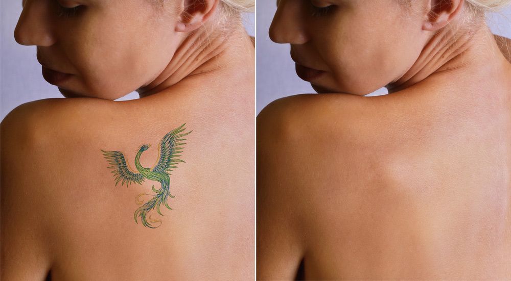 Before And After Tattoo Removal — Jina Robinson Skin-Cos-Medix In Albion Park NSW