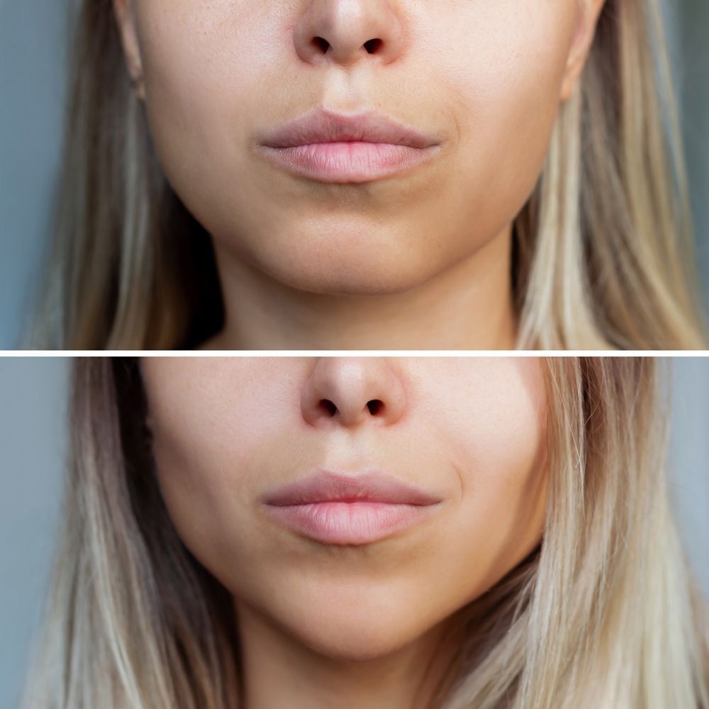Woman's Face With Jaws And Chin Before And After — Jina Robinson Skin-Cos-Medix In Albion Park NSW