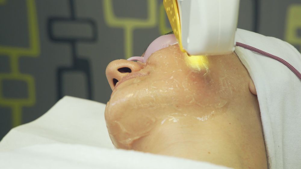 Close Up View Of The Woman Wearing Glasses Receiving Laser Skin Care On Face — Jina Robinson Skin-Cos-Medix In Albion Park NSW