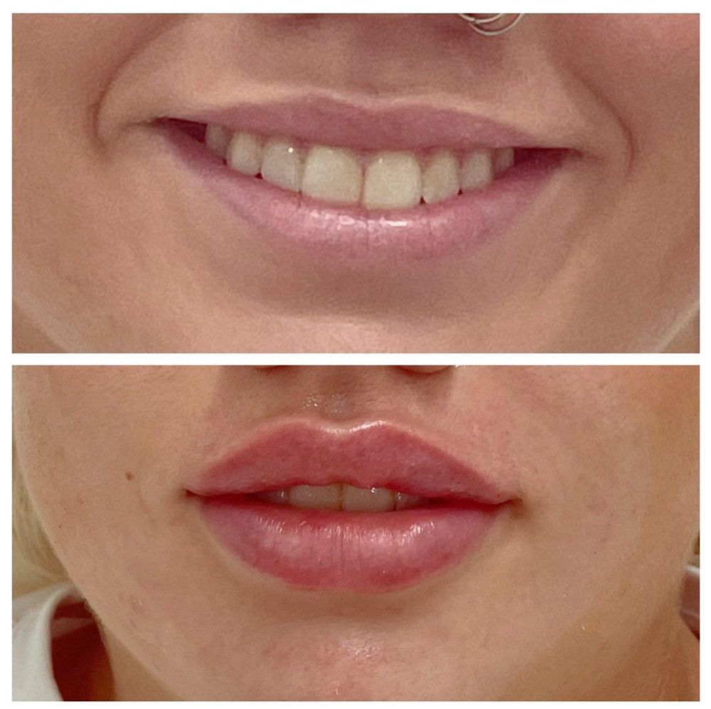 Facial Skin Care Treatment Before And After — Jina Robinson Skin-Cos-Medix In Albion Park NSW