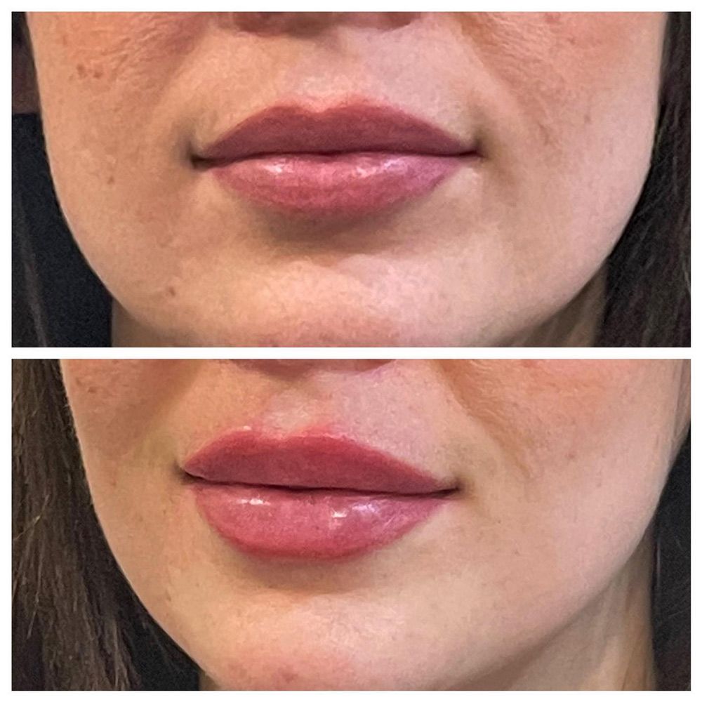 Before And After Lip Filler Treatment — Jina Robinson Skin-Cos-Medix In Albion Park NSW