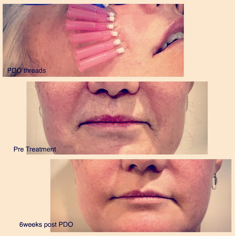 Woman With Before And After Treatment For Acne — Jina Robinson Skin-Cos-Medix In Albion Park NSW