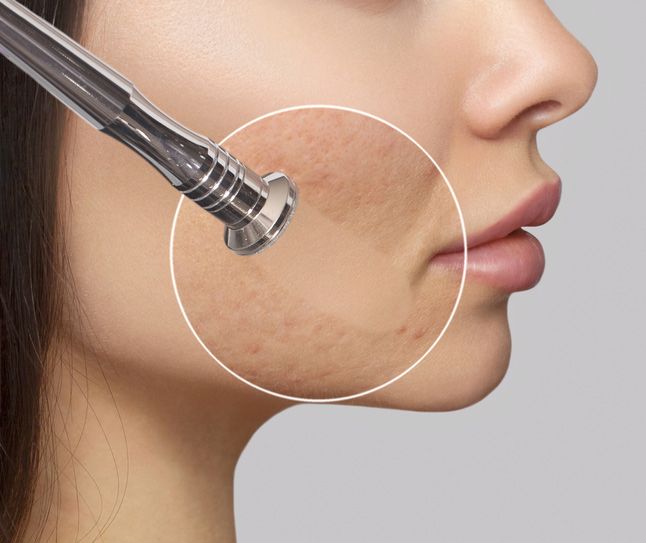 The Cosmetologist Makes The Procedure Microdermabrasion Of The Face Skin — Jina Robinson Skin-Cos-Medix In Albion Park NSW