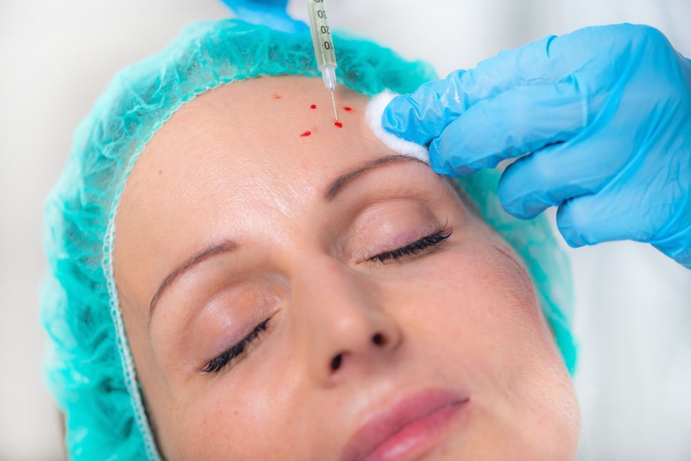 Woman Receives Platelet Rich Plasma Face Injection For-Reduction Of Skin Wrinkles — Jina Robinson Skin-Cos-Medix In Albion Park NSW