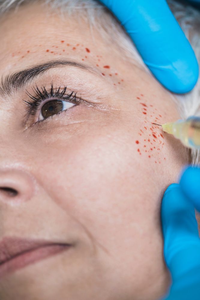 Mature Woman Receives Platelet Rich Plasma Face Injection Treatment For Reducing Wrinkles — Jina Robinson Skin-Cos-Medix In Albion Park NSW