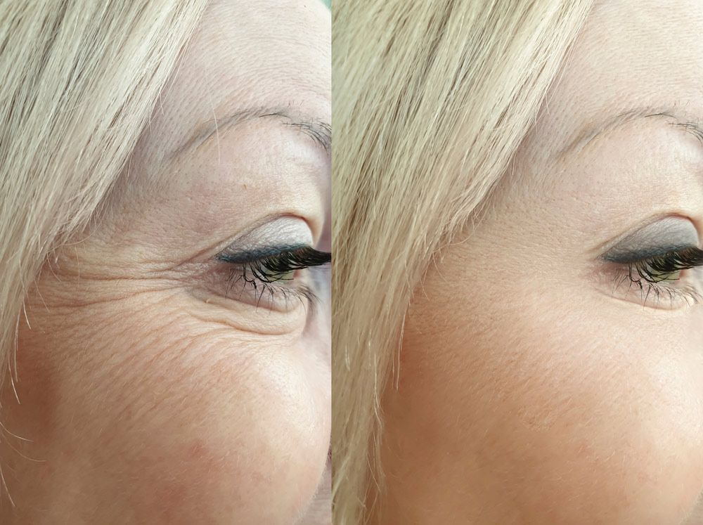 Woman Eyes Wrinkles After Treatment — Jina Robinson Skin-Cos-Medix In Albion Park NSW