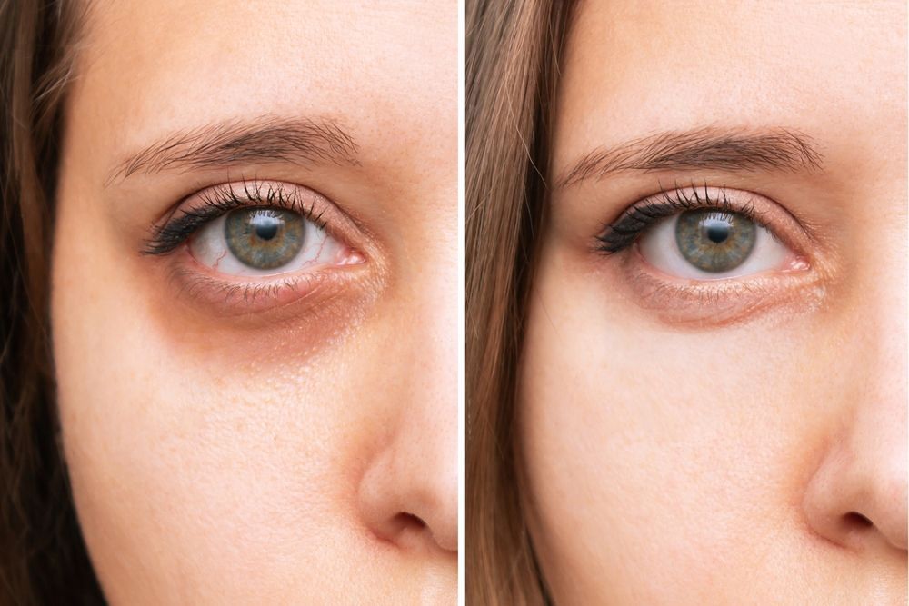 Woman's Face With Dark Circles Under The Eyes Before And After Treatment — Jina Robinson Skin-Cos-Medix In Albion Park NSW