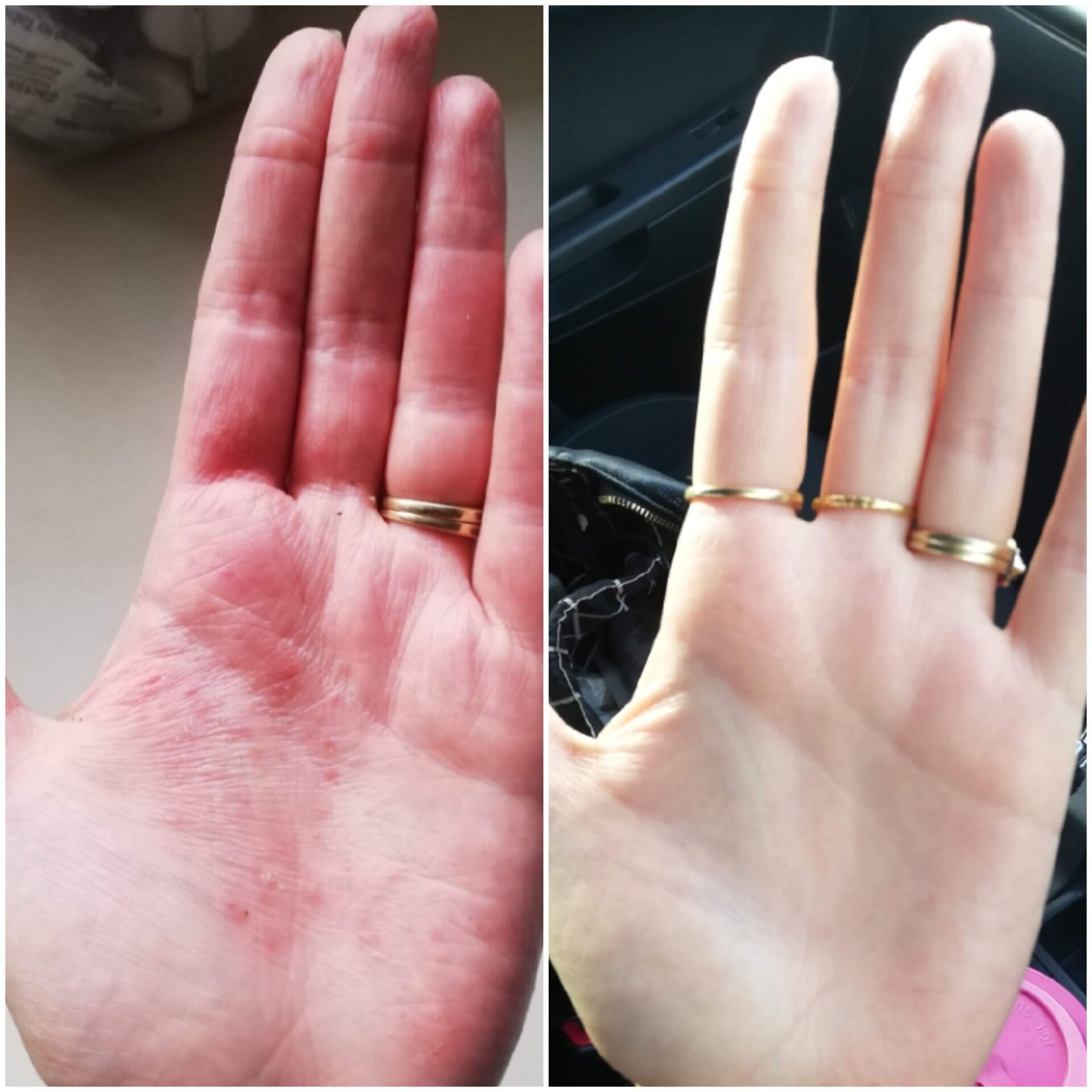 Inflamed dermatitis - 4 week treatment