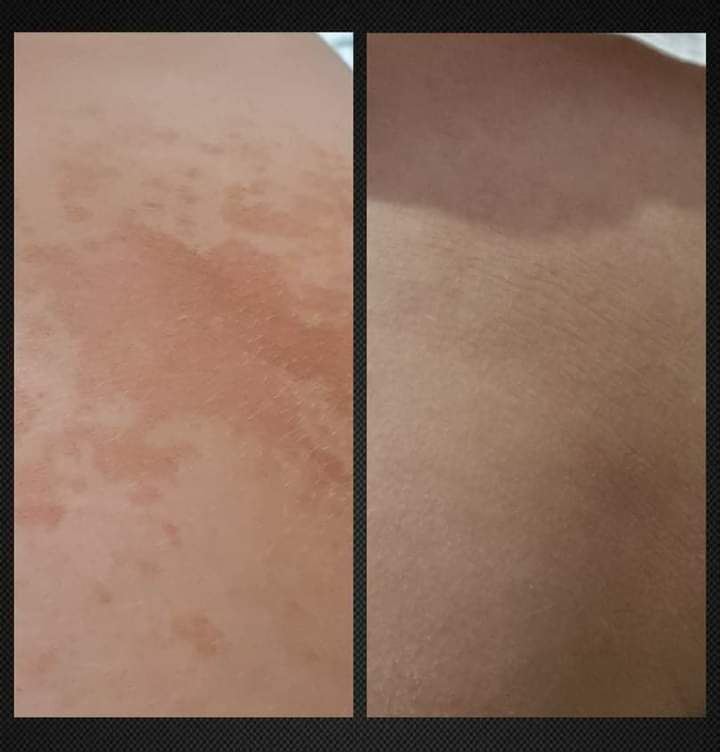 Pityriasis vericolor 4 week treatment