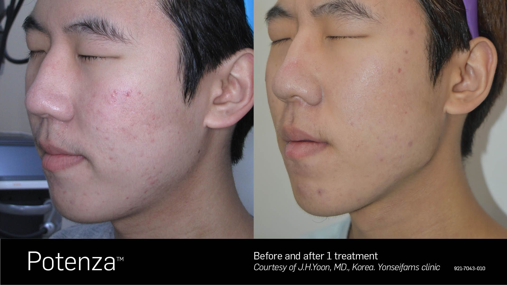 A before and after photo of a young man 's face