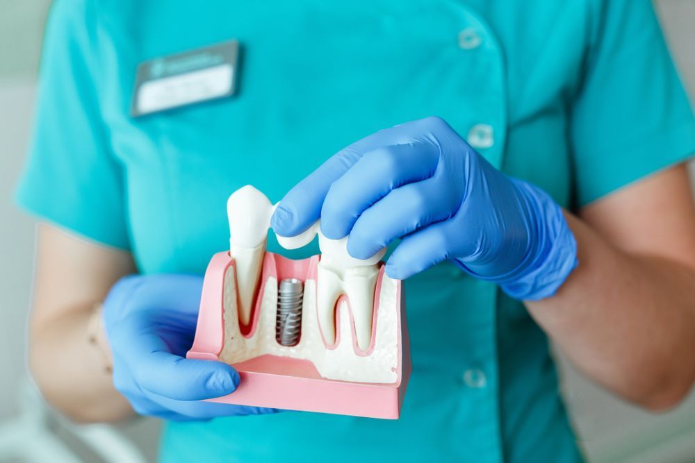 Hands of the Dentist Hold a Breadboard Model of The Tooth with an Implant — Dental Clinic in Buderim, QLD