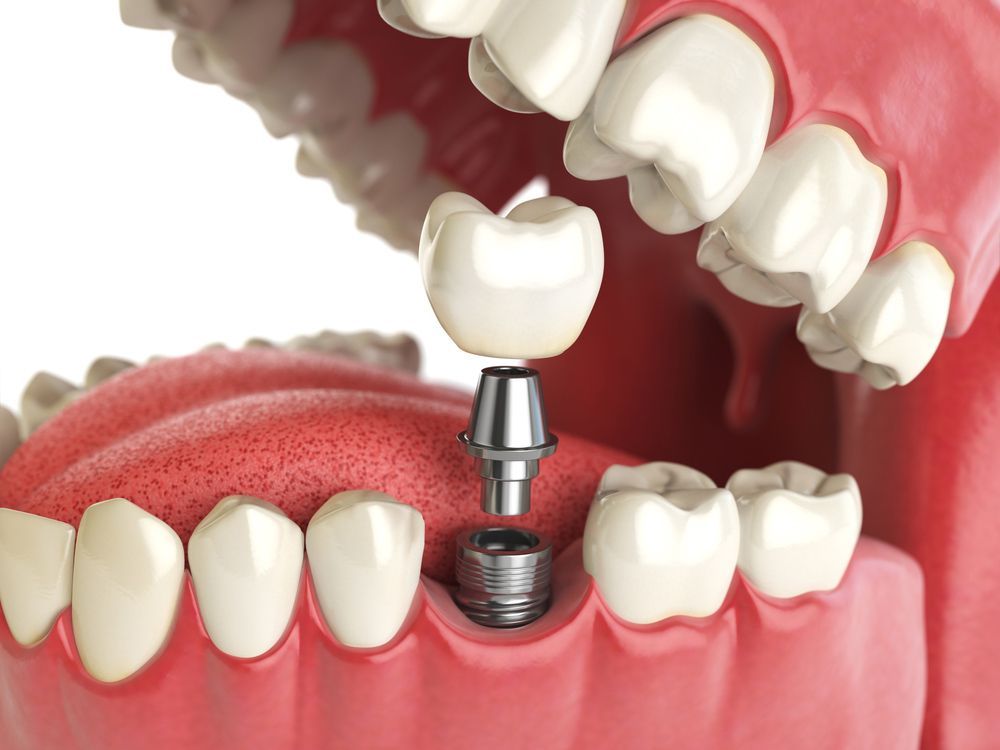 A Dental Implants