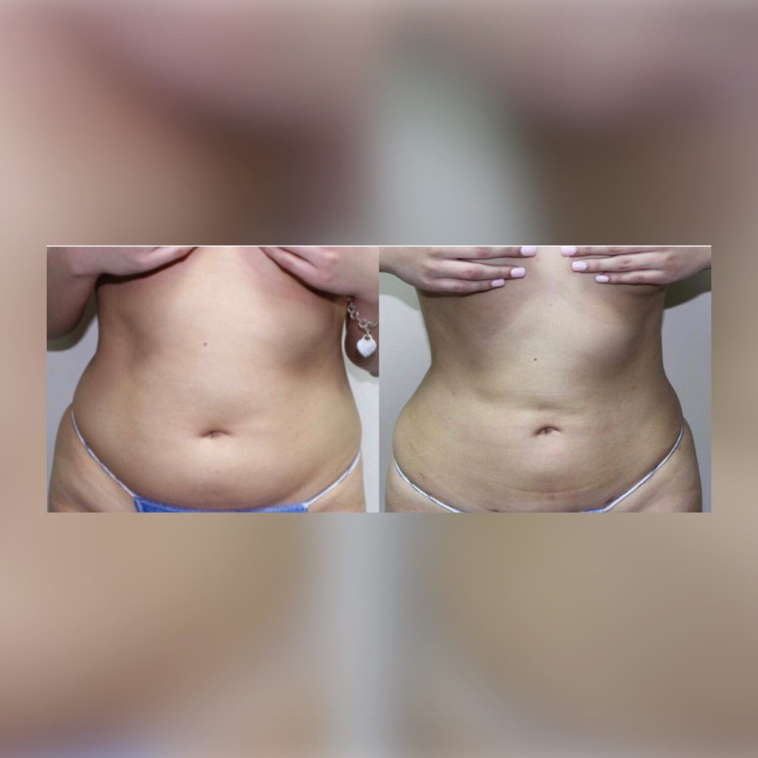 Smartlipo 2