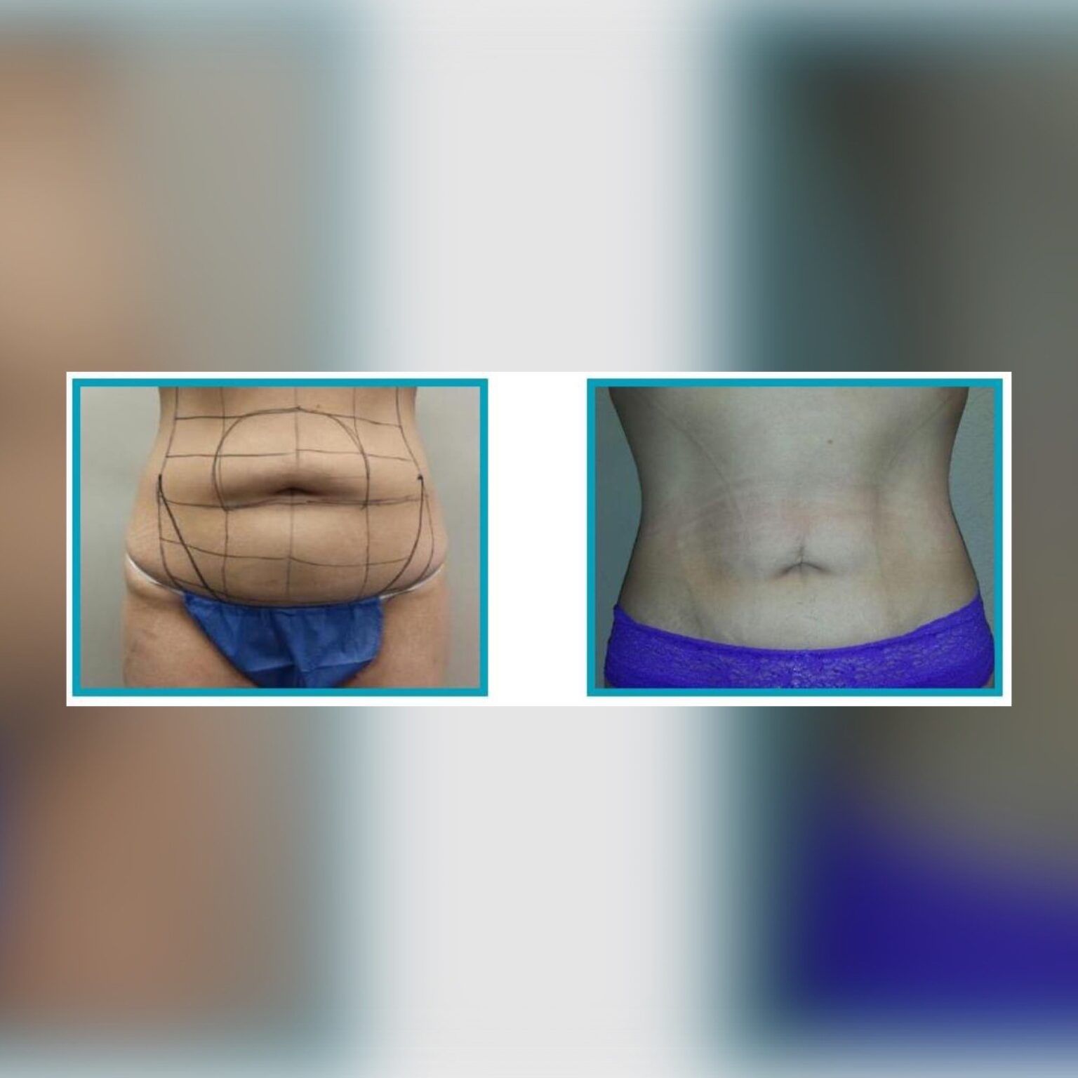 Smartlipo 5