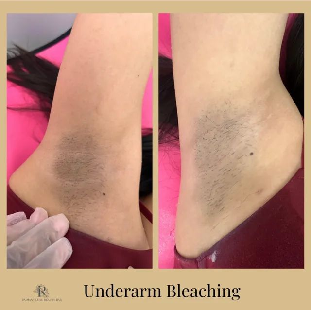 Before and after view of underarm bleaching: one with dark underarm hair, the other lighter after treatment.
