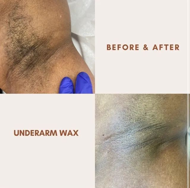 Before and after comparison of underarm waxing. Dark armpit with hair before, and clean, hair-free armpit after waxing.