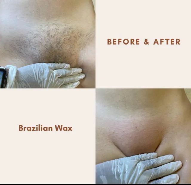 Before and after of a Brazilian wax: top left, hairy pubic area; bottom right, hairless pubic area. Hands in gloves touch the skin.