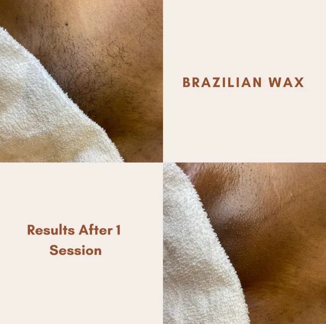 Before and after comparison of Brazilian wax results. The left side shows hair before waxing, the right shows smooth skin after one session.