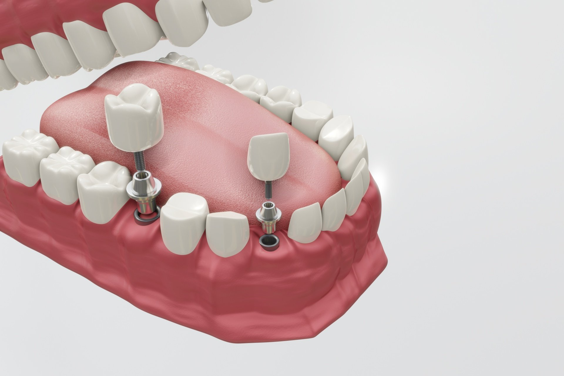 Implante dentário em Belém