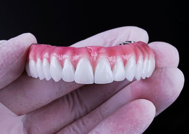 Como é feito o tratamento ortodôntico com implante dentário? – Oral Dente